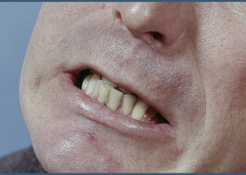 America’s Teeth Grinders Are Turning to Botox