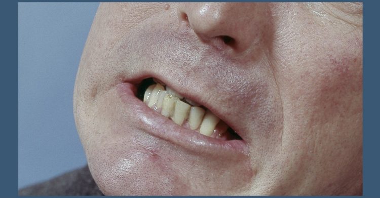 America’s Teeth Grinders Are Turning to Botox